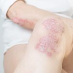 Body&Bess psoriasis